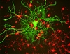 نقش بالینی نوروفیلامنت ها در تشخیص بیماری های مغز و اعصاب